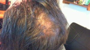 A balding head.